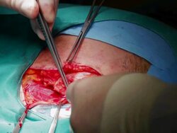 cutting artery with medical laser Stock Footage