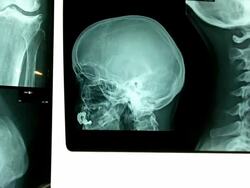 X-Ray (HD) Stock Footage