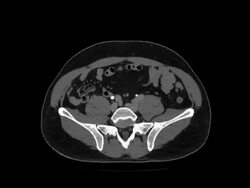 CAT Scan of Thorax and Abdomen Stock Footage