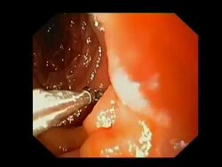 Biopsy of the human duodenum, endoscope view. The duodenum is the first part of the small intestine. This biopsy involves the removal of a small part of the wall of the duodenum, which is then tested for coeliac disease (gluten intolerance). Stock Footage