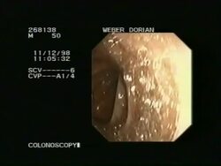 Colonoscopy - endoscopic examination of colon Stock Footage