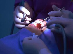 dental procedure Stock Footage