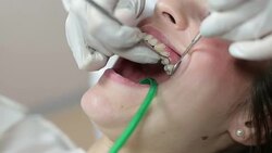 Mending patient's teeth Stock Footage
