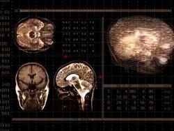 Brain MRI Stock Footage