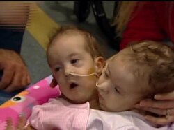 Conjoined twins Abygail and Madysen Fitterer, of Bismarck, N.D., will undergo separation surgery at the Mayo Clinic on Wednesday. The girls, who were born Aug. 8 in Minneapolis, are joined at the chest and share their front chest wall. News Clip