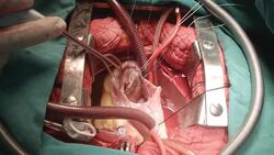 Herat surgeon perform Tricuspid Valve Repair Stock Footage