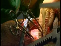 CU Surgeon's hands stitching up inside cavity during operation, organ pulsing Stock Footage