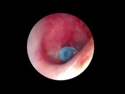 ear tube Stock Footage