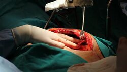 Close up view of open heart surgery Stock Footage