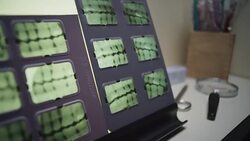Several dental X-rays of teeth are displayed on a light box at a dentist's office. Stock Footage