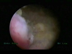 Laser prostate surgery. Endoscope image of a greenlight HPS laser inside the urethra of a patient undergoing a prostatectomy (removal of the prostate gland). The guide light is pink, the laser is yellow and dead cells are white.. Stock Footage
