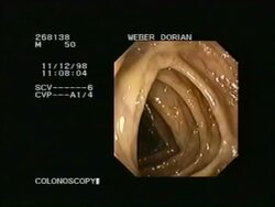 Colonoscopy - endoscopic examination of colon Stock Footage