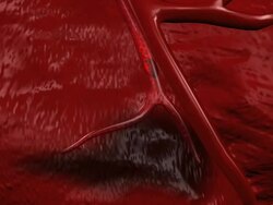 Blocked coronary artery reopened by a wire stent. The part of the heart muscle not receiving sufficient blood is dark in colour Stock Footage