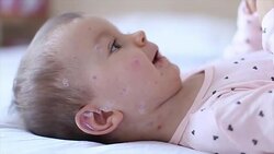 Crying baby girl with measles Stock Footage