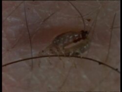 BCU Head lice mating and feeding together, United Kingdom; SEQUENCE OF CLIPS, SPECIAL TERMS APPLY Stock Footage
