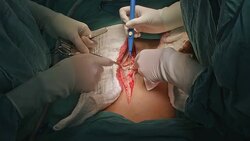 Surgeon open abdomen Stock Footage