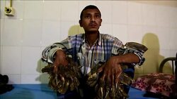 CLEAN : Surgery for Bangladeshs Tree Man to remove warts News Clip