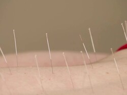 "CU Shot of Acupuncture needles / Beverly Hills, California, United States" Stock Footage