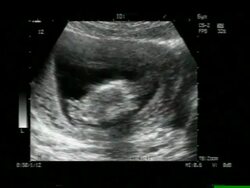 Twins, ultrasound scan. Stock Footage