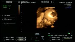 Pregnant 4D ultrasound Stock Footage