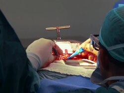 Focused surgeon operates a patient Stock Footage