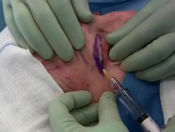 Facelift operation, clip 18 of 24. Stock Footage