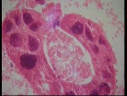 Ovarian cancer test uses proteins from woman's blood News Clip