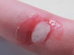 Burn wound disinfection Stock Footage