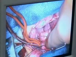 CU Monitor showing doctors operating on childs heart /  Little Rock, Arkansas, USA Stock Footage