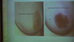 Fighting taboos which keep women ignorant about breast cancer News Clip