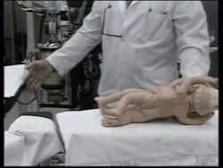 USA: SURGEONS OPERATE TO SEPARATE SIAMESE TWINS News Clip