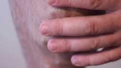 varicose veins Stock Footage