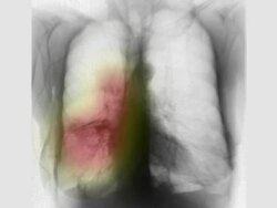 ZI on a chest x-ray showing lung cancer and chronic obstructive lung disease, COPD Stock Footage