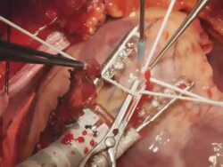 real coronary artery bypass surgery footage : cut blood vessel open Stock Footage