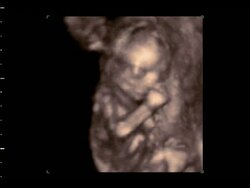 Foetus moving its arm, 4D ultrasound scan.. Stock Footage