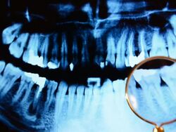Magnifying glass over dental x-ray image Stock Footage