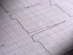 Medical ECG graph. Stock Footage