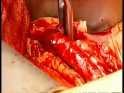 ECU Artery pulsing inside body cavity during operation Stock Footage