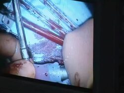 CU  Monitor showing doctors attaching tubes to child's heart /  Little Rock, Arkansas, USA Stock Footage