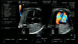 Pregnant 4D ultrasound Stock Footage