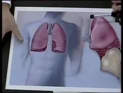 Doctor presser on Clinton heart op, earlier Clinton arrival News Clip