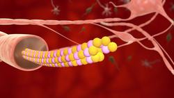 Alzheimer's starts in people as young as 20, much earlier than previously thought Instructional Video