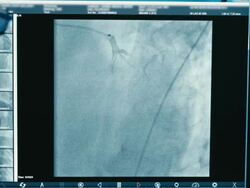 Doctor monitoring injection process into blood vessels Stock Footage
