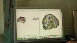 Scientists claim they can see pain on brain scans News Clip