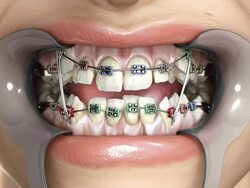 Computer generated teeth crowding time-lapse. Stock Footage