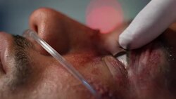 TU Doctor checking pupil response of ICU patient Stock Footage