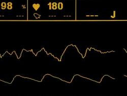 ECG Monitor Stock Footage