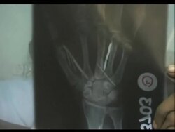 Doctors removed 13 nails and five needles from a Sri Lankan maid who says the couple she worked for in Saudi Arabia hammered them into her body. News Clip