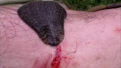 A large leech sucks blood from a man's arm. Stock Footage