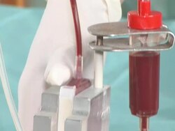 transfusion procedure (purification) of blood Stock Footage